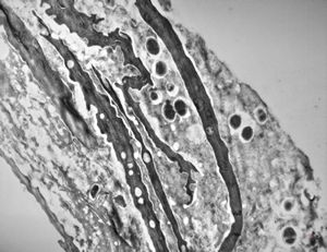 M, 60y. | otitis externa … microbes (fungi?) on the epidermal surface